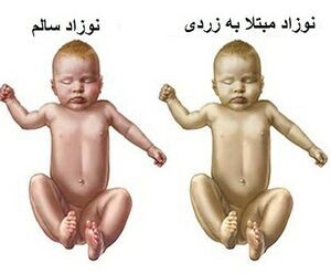 زردی نوزاد چیست؟ آشنایی با علل و درمان آن 3 درمان زردی نوزادان