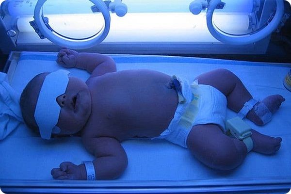 عوارض استفاده از دستگاه زردی نوزاد