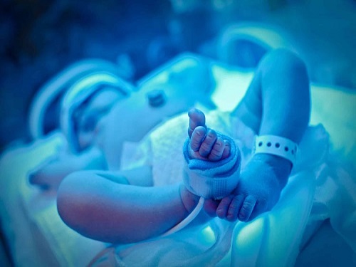 از کجا بفهمیم زردی نوزاد خوب شده؟ 3 علائم وجود زردی در نوزادان